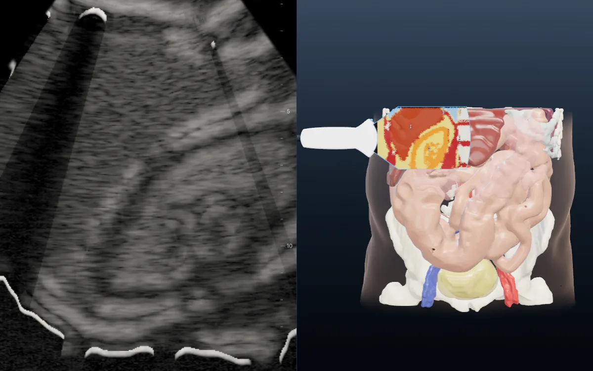 POCUS-Simulator mit Ultraschallbild und 3D-Anatomie